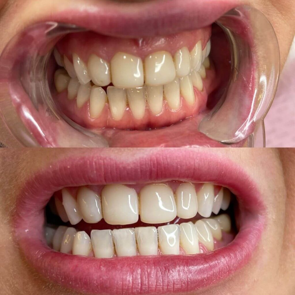 11_kosmetyczne_wybielane_zebow_ustron_brenna_gorki