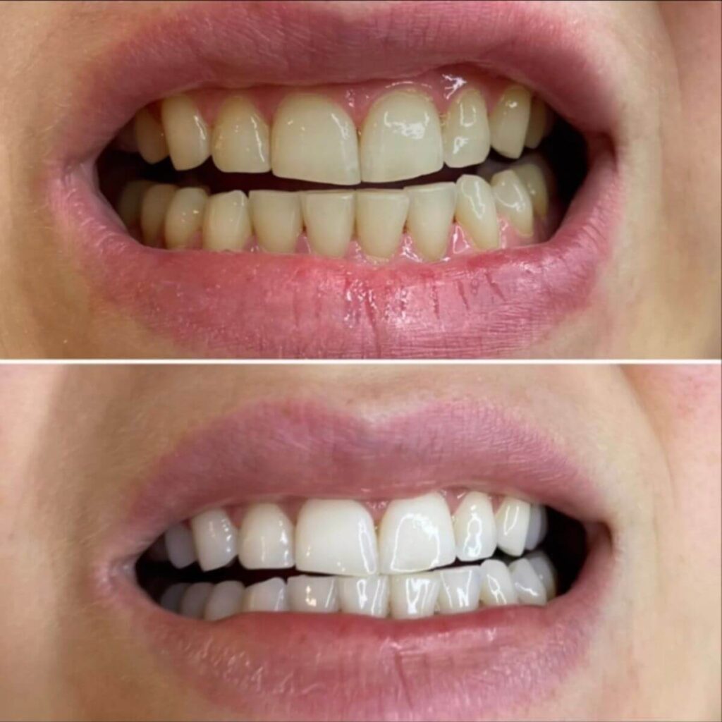 15_kosmetyczne_wybielane_zebow_ustron_goleszow_cisownica