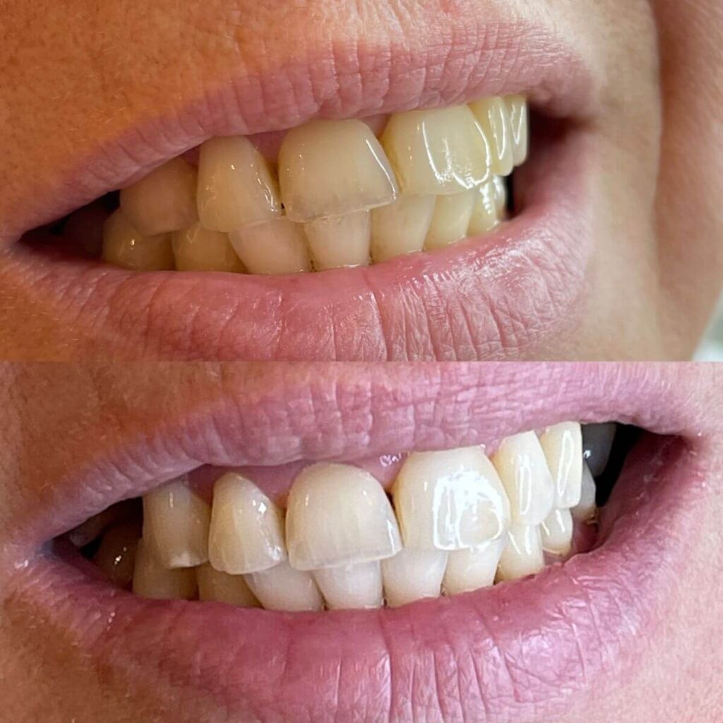 17_ustron_kosmetyczne_wybielane_zebow_super_efekt