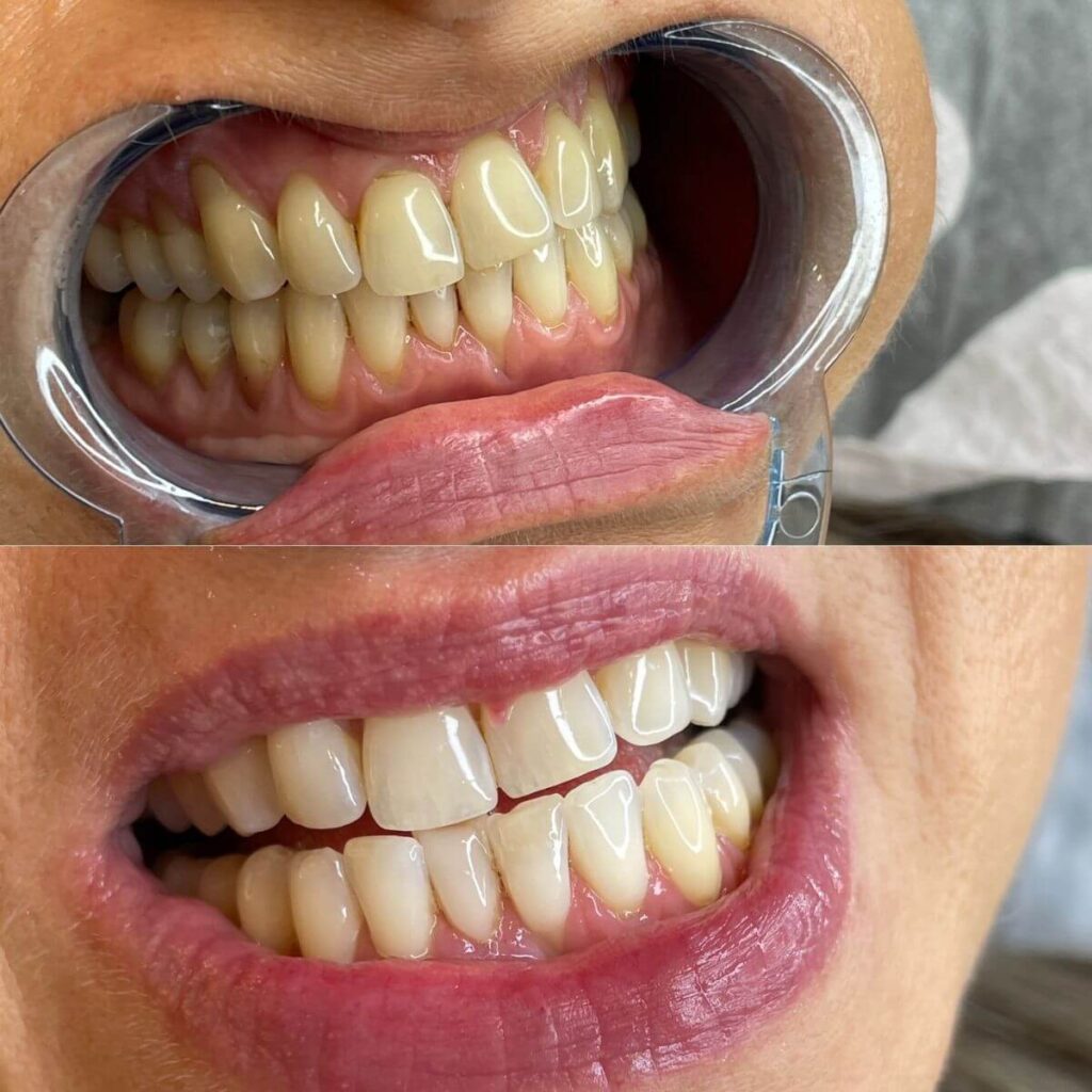 19_ustron_kosmetyczne_wybielane_zebow_super_efekt