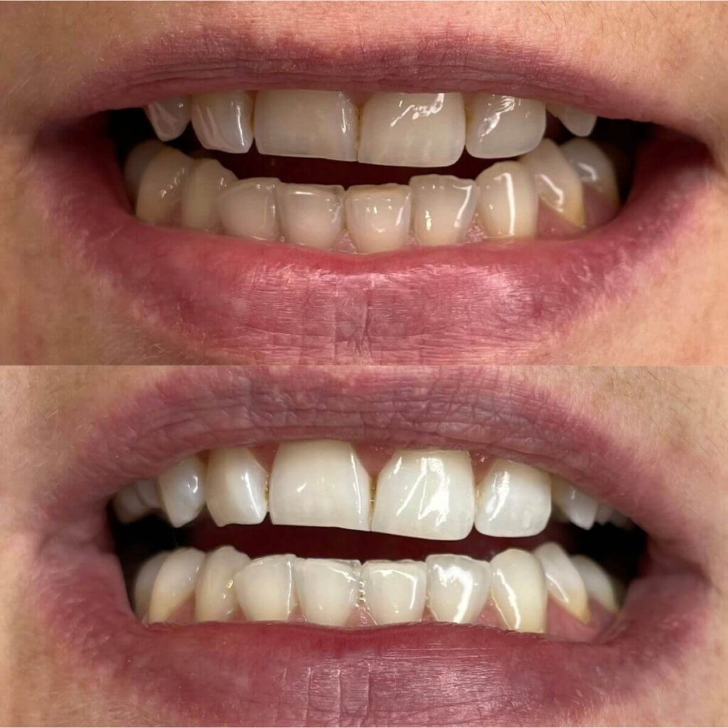 1_ustron_kosmetyczne_wybielane_zebow_efekt_wow