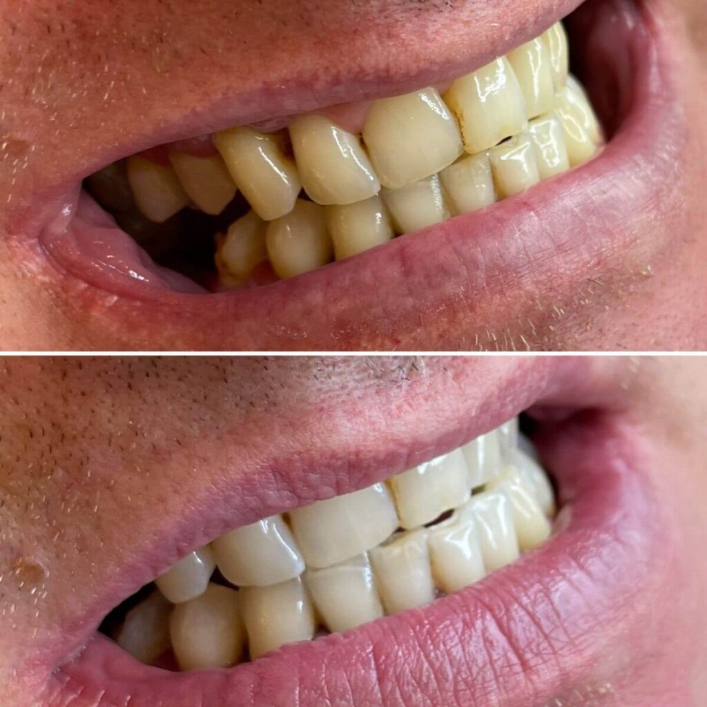 21_ustron_kosmetyczne_wybielane_zebow_super_efekt