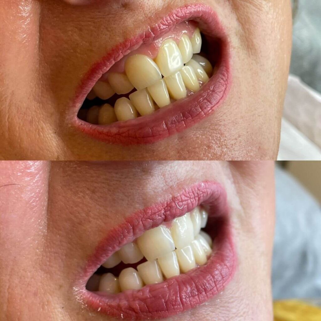 25_ustron_kosmetyczne_wybielane_zebow_super_efekt