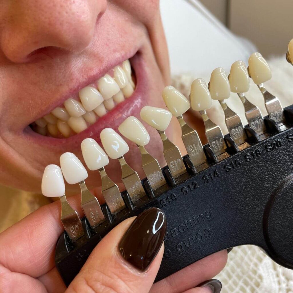 3_ustron_kosmetyczne_wybielane_zebow