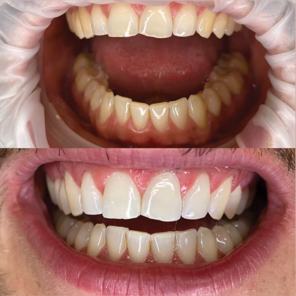 5_kosmetyczne_wybielane_zebow_ustron_goleszow_cisownica