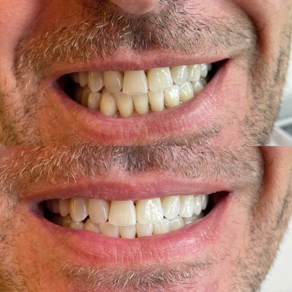 7_ustron_kosmetyczne_wybielane_zebow_super_efekt